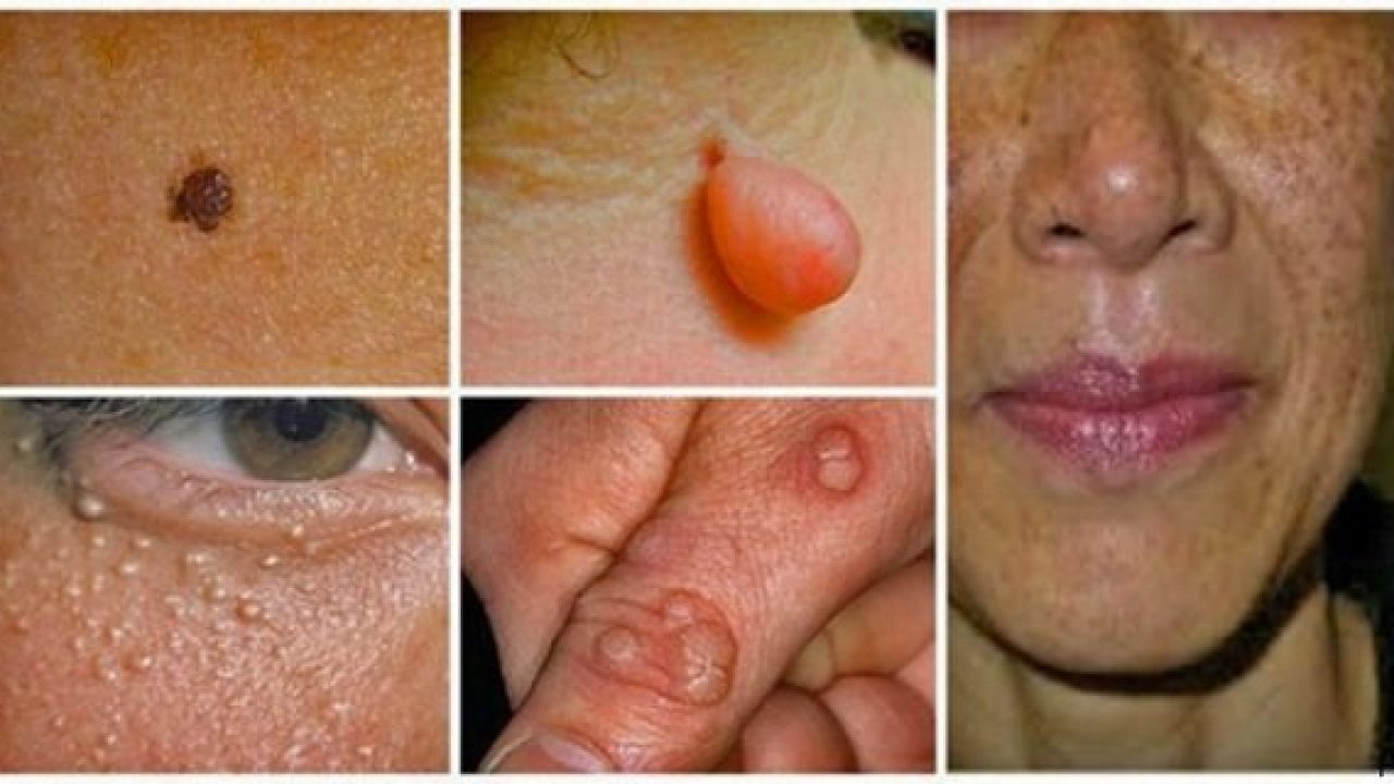 Destroy your moles, warts, blackheads, skin tags and age spots completely naturally