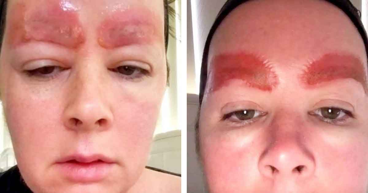 Mom’s eyebrow skin suddenly falls off – after common treatment goes horrifically wrong