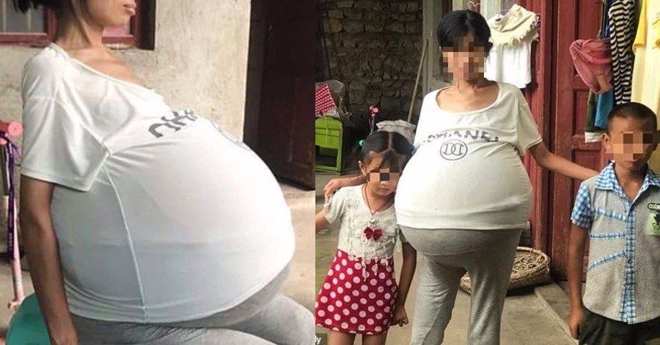 The mother of two has an unusual medical issue that causes her tummy to weigh 44 pounds