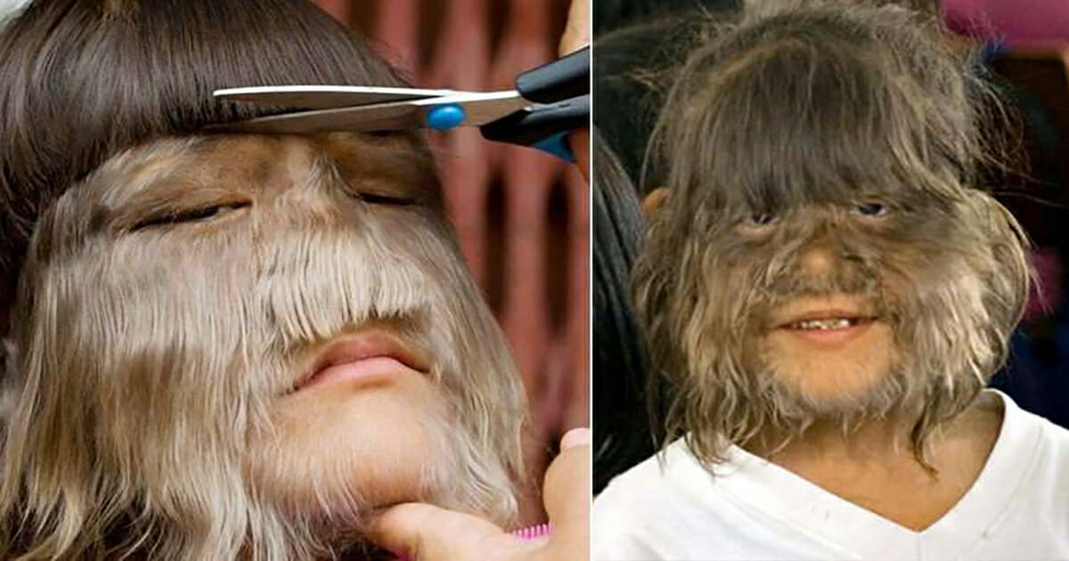 19-year-old was known as ‘world’s hairiest girl’: Now she’s shaved it all off