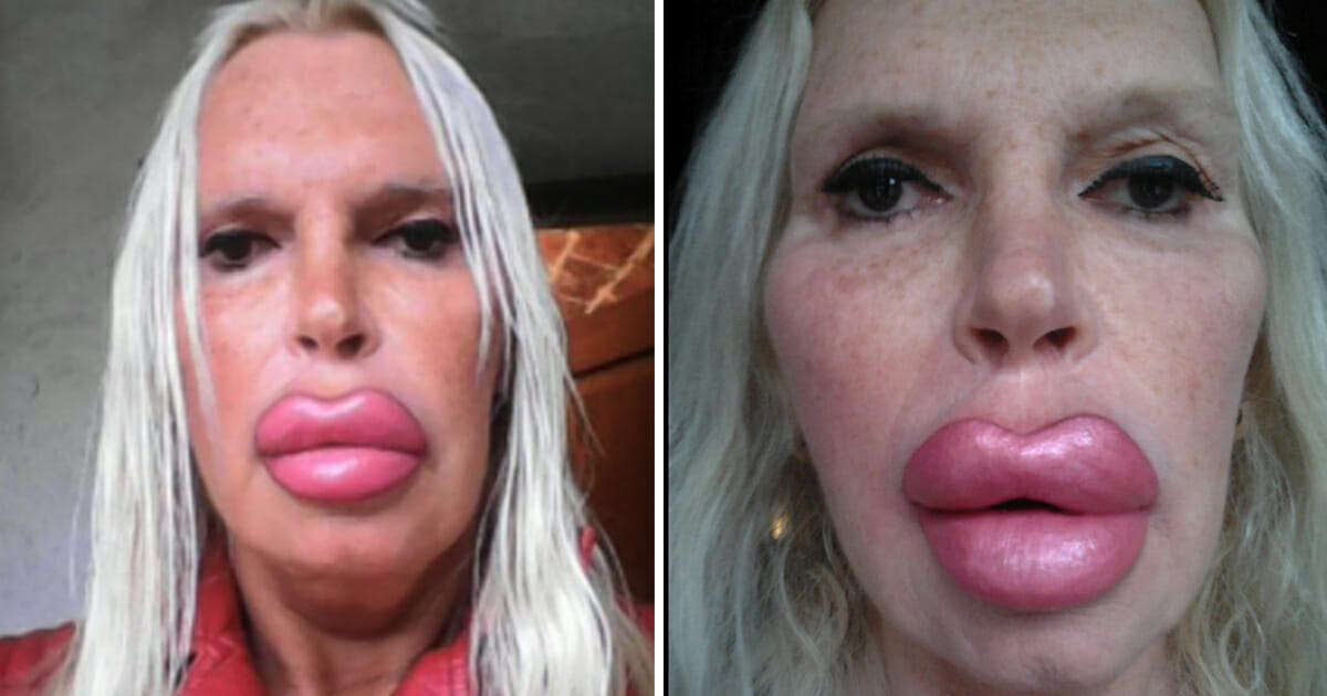 Married transgender woman spends $76,000 on surgery – won’t stop until she achieves ‘perfection’