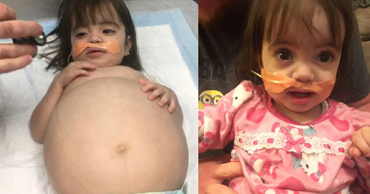 Little girl who looked 8 months’ pregnant because of deadly disease is saved thanks to dad’s kidney donation