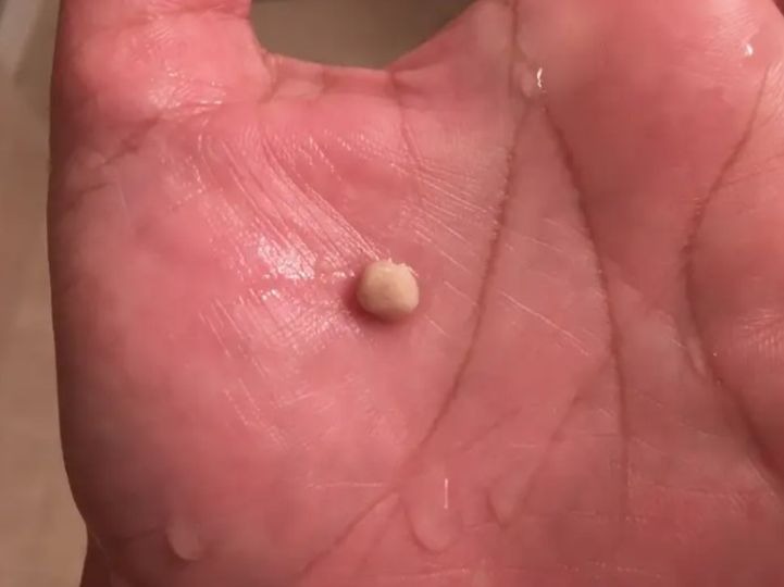 The Fascination with Tonsil Stone Removal